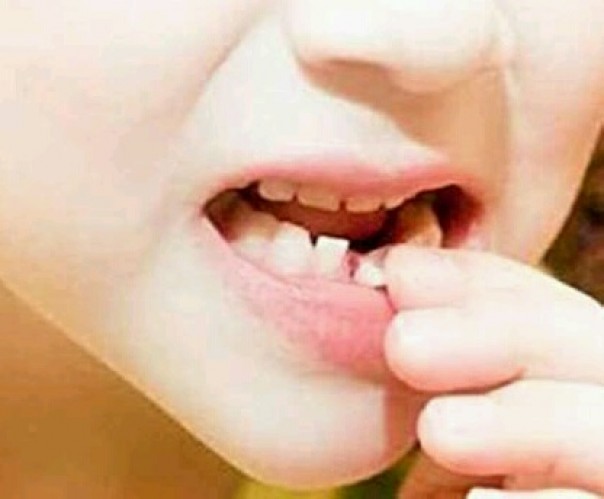 Mimpi Gigi Copot Apakah Pertanda Keluarga Dekat Akan Meninggal Beginilah Menurut Pakar Mimpi Riau1 Com